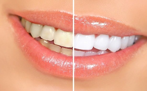 How Much Does Teeth Whitening Cost ?